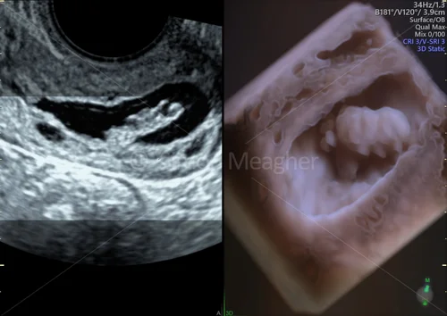 Cervical Polyp -3D surface Render — Dr Simon Events & Webinars
