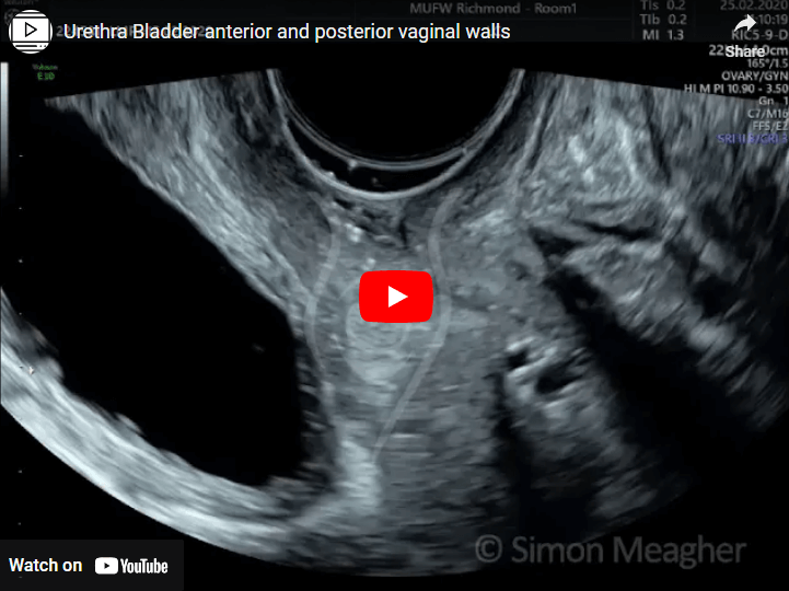 Urethra Bladder anterior and posterior vaginal walls