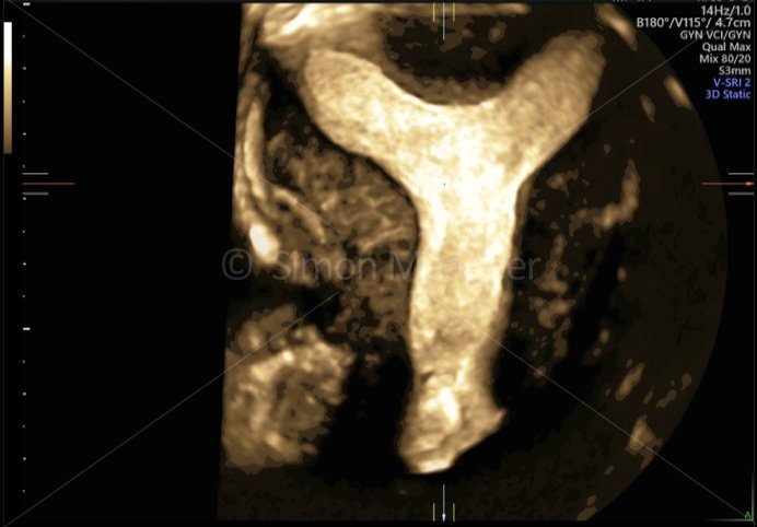 Subseptate Uterus