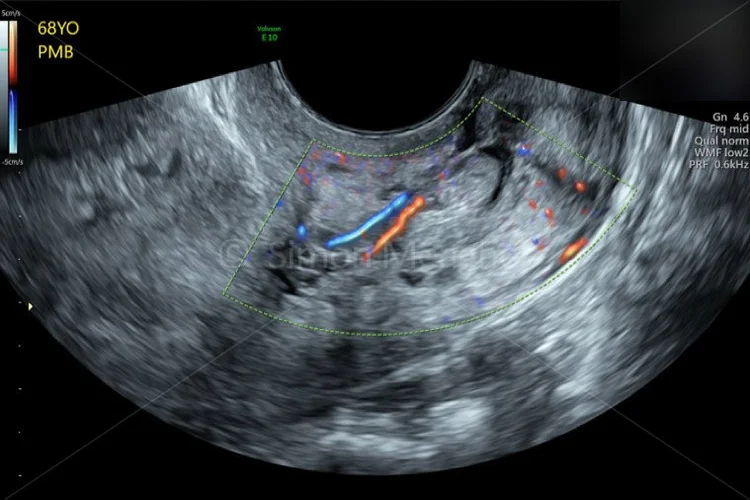 Cervical- Polyp- feeder vessels with Radiant Flow — Dr Simon Events