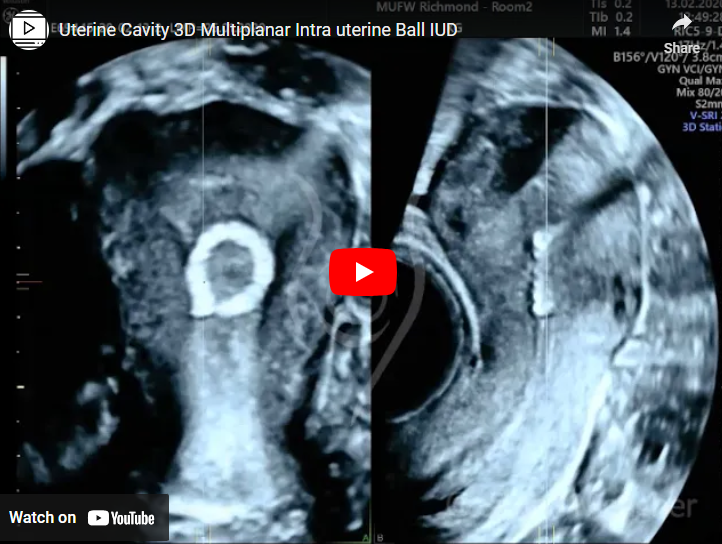 Uterine Cavity 3D Multiplanar Intra uterine Ball IUD