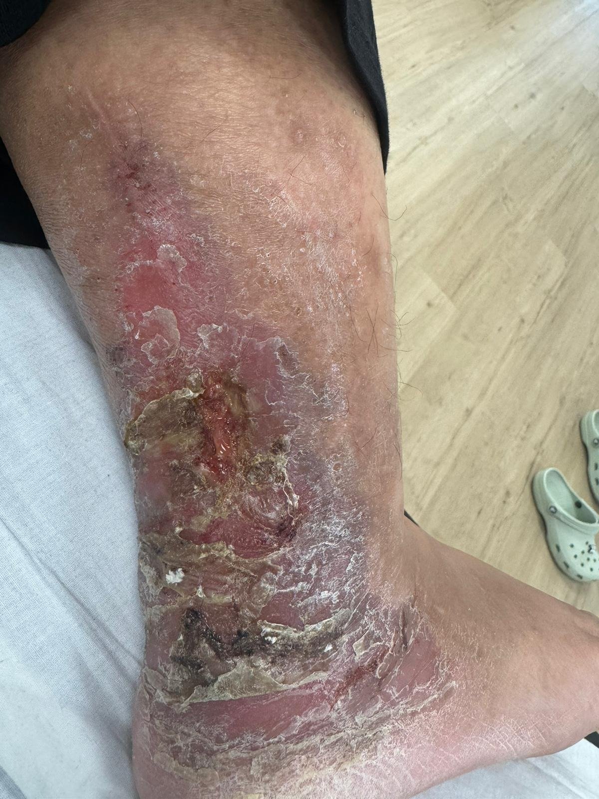 Hyperbaric Oxygen Therapy (HBOT) - Leg Ulcer Recovery