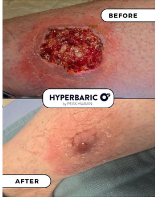Patient Success Story: Remarkable Healing with HBOT