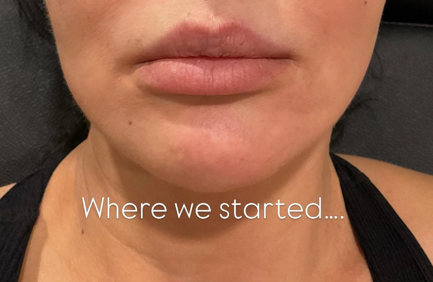 Subtle changes, major harmony😮&zwj;💨

Jowls softened ☑️
Marionette shadows improved ☑️
Enhanced chin definition ☑️

Strategic placement to restore balance and refine the lower face✨

When 2 become 1🤍
RHA + Defyne working together😍

📍Two Point O 