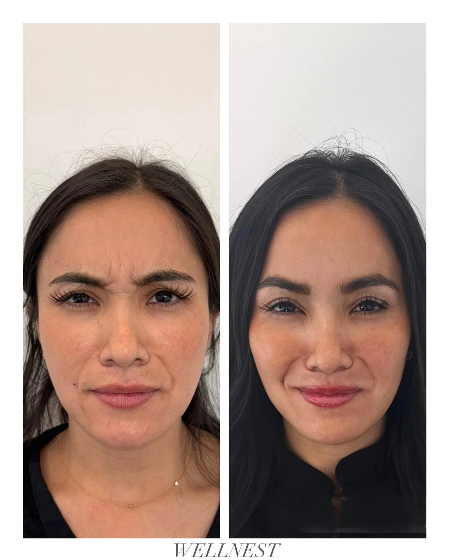A little &lsquo;tox refresh 

Wishing you smoother days this September 🤍

💉: @resultsbyrachael 

#atxmedspa #austintx #wellnestaesthetics #austinmedspa #atxinjector