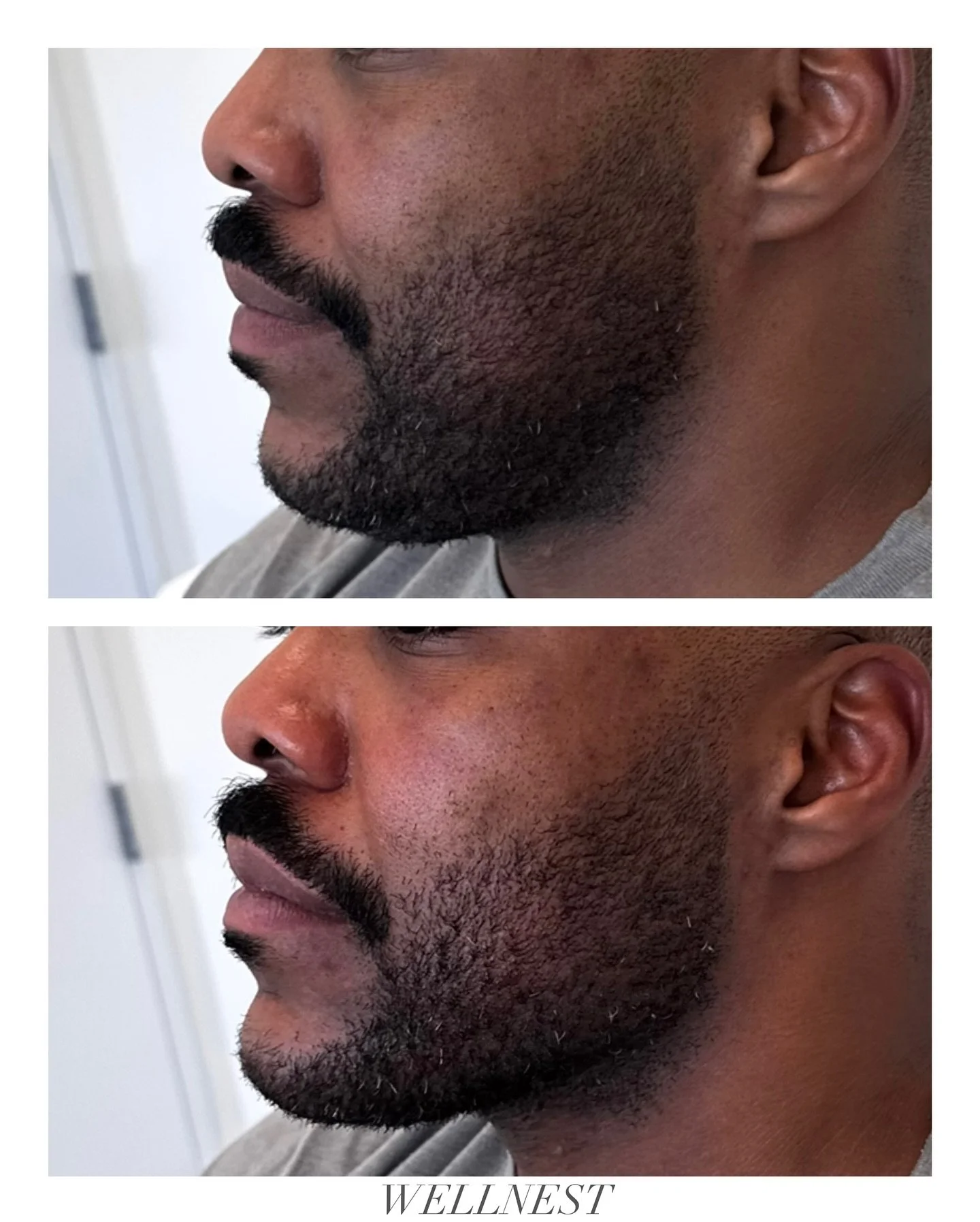 Proof that structure changes everything 🔑 

Chin + jaw transformation by @injectorbrooklyn 

#atxmedspa #austintx #wellnestaesthetics #austinmedspa #atxinjector