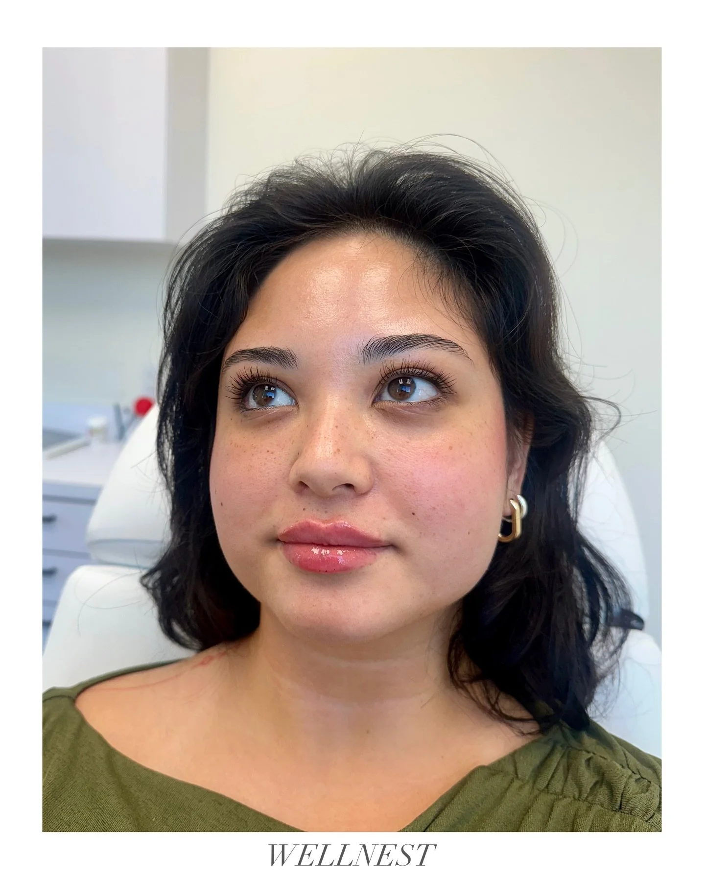 A touch of filler restores hydration, smooths fine lines, and enhances natural volume. 

Subtle + result-driven = the perfect balance.

Sometimes the smallest change makes the biggest difference. Natural, hydrated lips that look as good as they feel.
