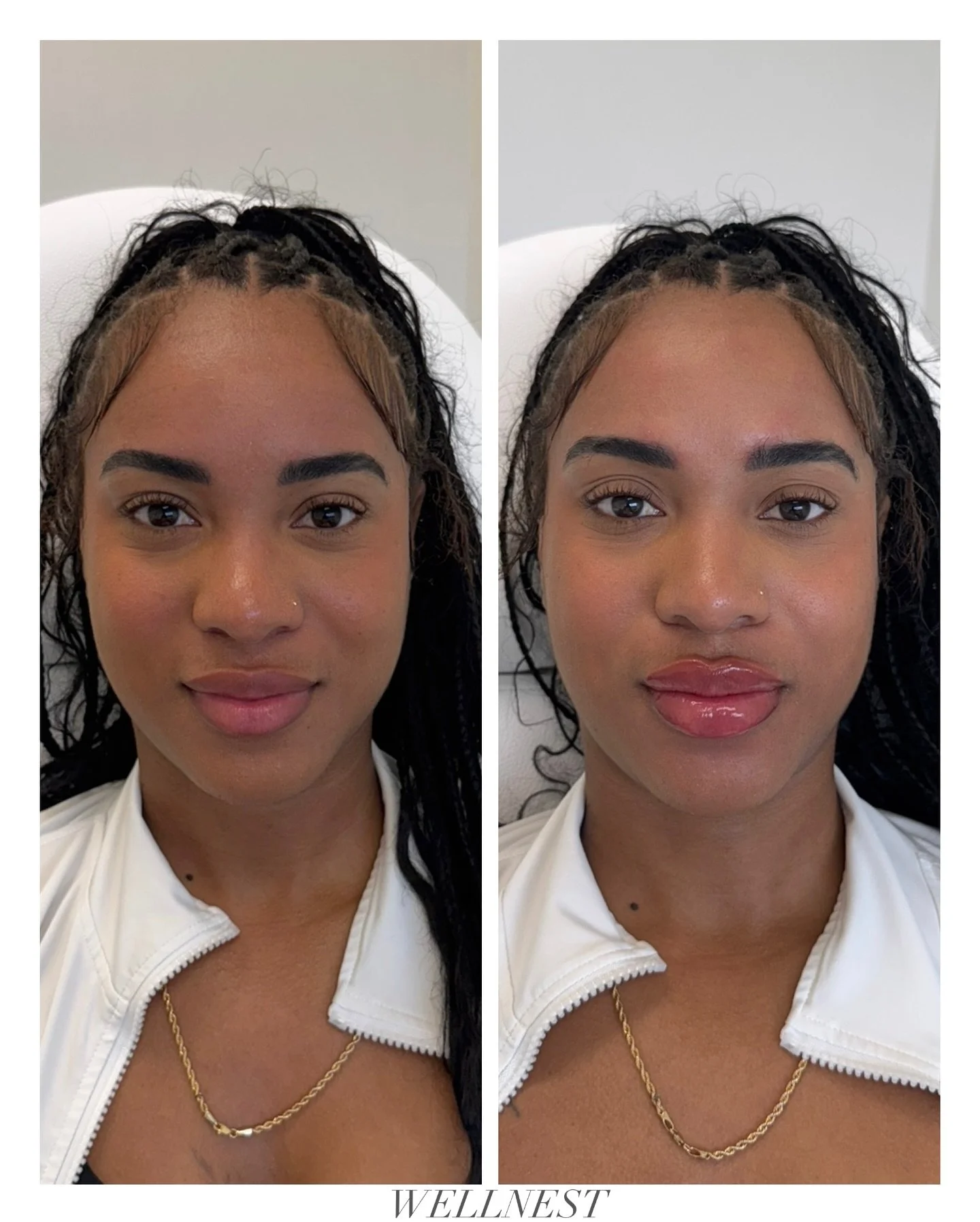 Natural enhancement, noticeable difference. 💋 

Let&rsquo;s create your perfect results! Schedule your consult today. 

Lip treatment by @injectorbrooklyn 

#atxmedspa #austintx #wellnestaesthetics #austinmedspa #atxinjector