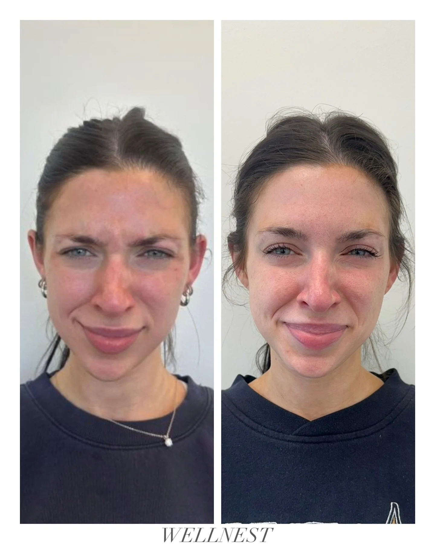 Our favorite kind of before and after 😍

Take advantage of our Black Friday deal all month! 20% off all services including all wrinkle relaxers. 

Things to consider 🤍
&bull; Wrinkle relaxers take about 2 weeks to fully set.
&bull; A follow-up appo