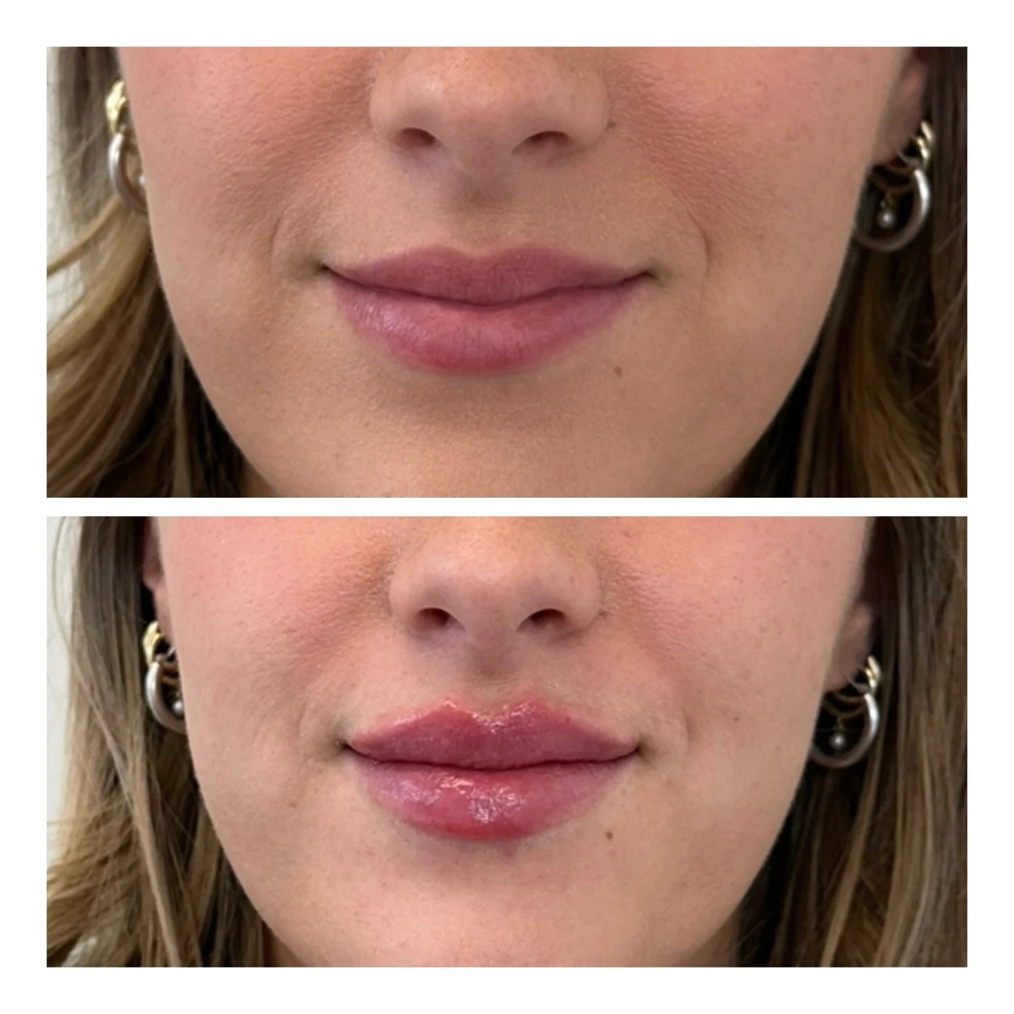 Roses are red,
Violets are blue,
Your lips look good&hellip;
But imagine them a little fuller too. 💌💉

$599 Lip filler promo all of February 💋

#wellnest #atxmedspa #atxlipfiller