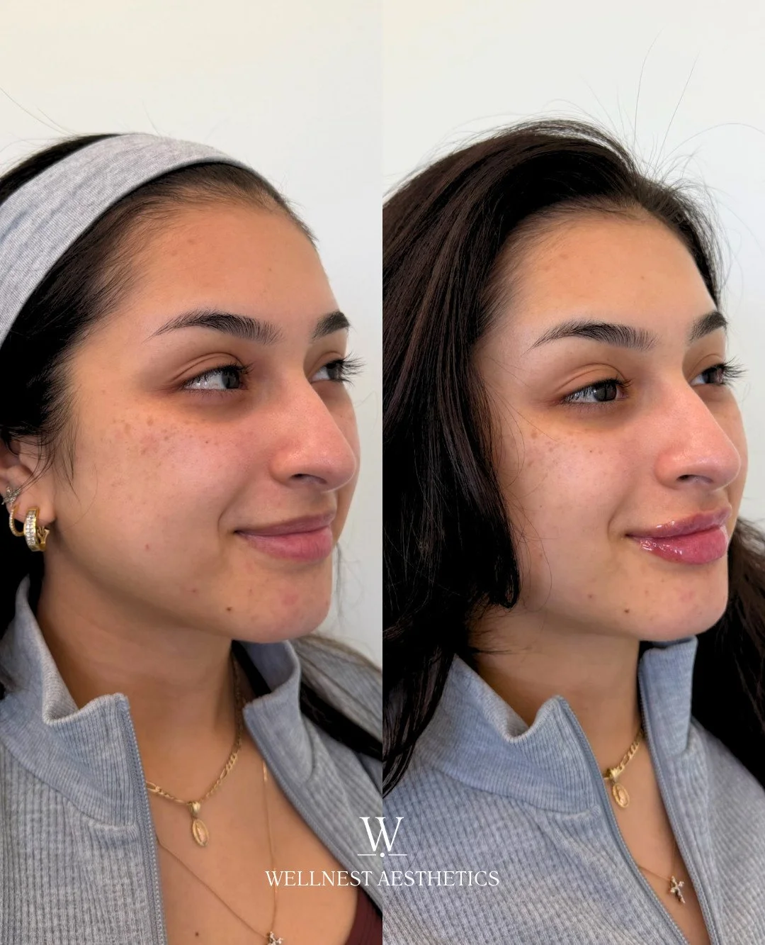 Lip filler isn't about creating a different lip.

It's about enhancing the one you already have.

This treatment focused on:
&bull; Improving hydration and structure
&bull; Enhancing border definition

The goal is always harmony.

💉: @resultsbyracha