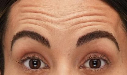 Before Botox Treatment