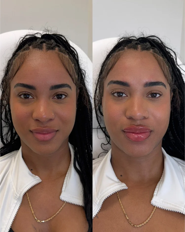 Lip filler before and after result