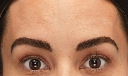 After Botox Treatment