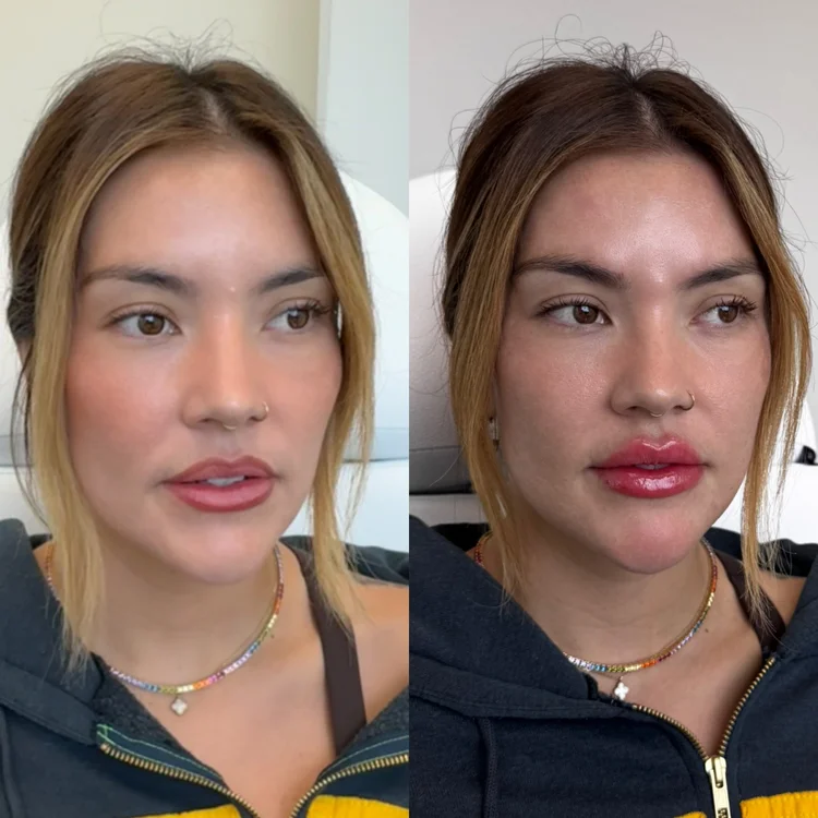 Lip filler before and after result