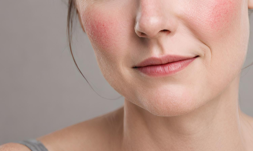 How to avoid Rosacea