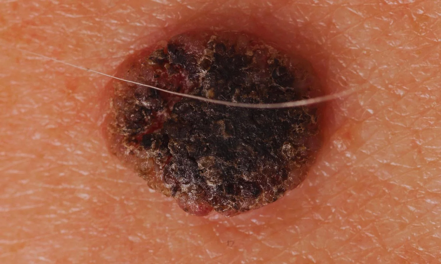 melanoma.jpg