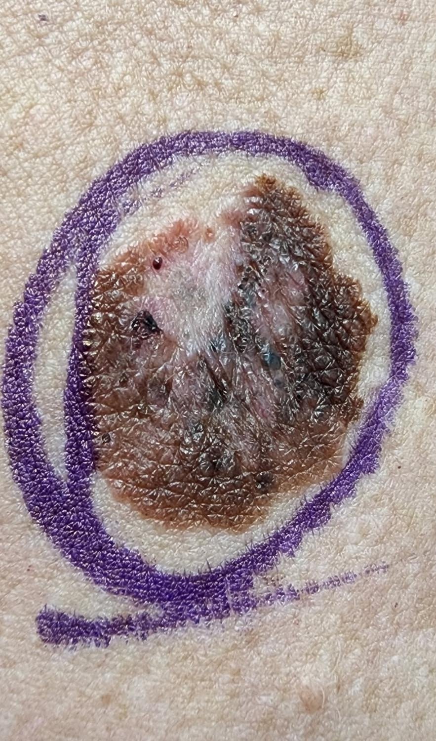 melanoma_1.jpg