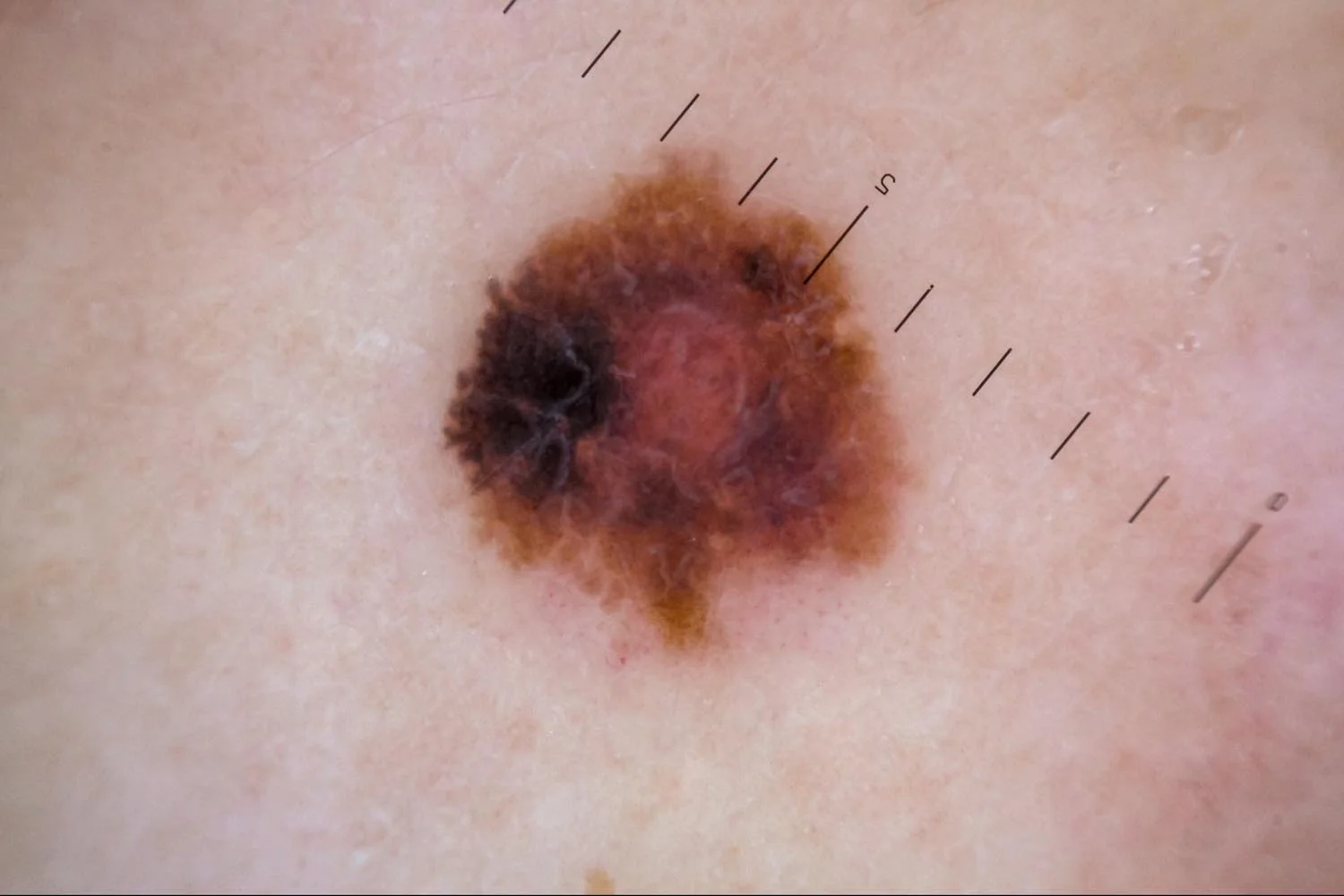 melanoma2.jpg