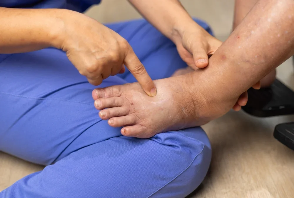 Lymphedema Therapy