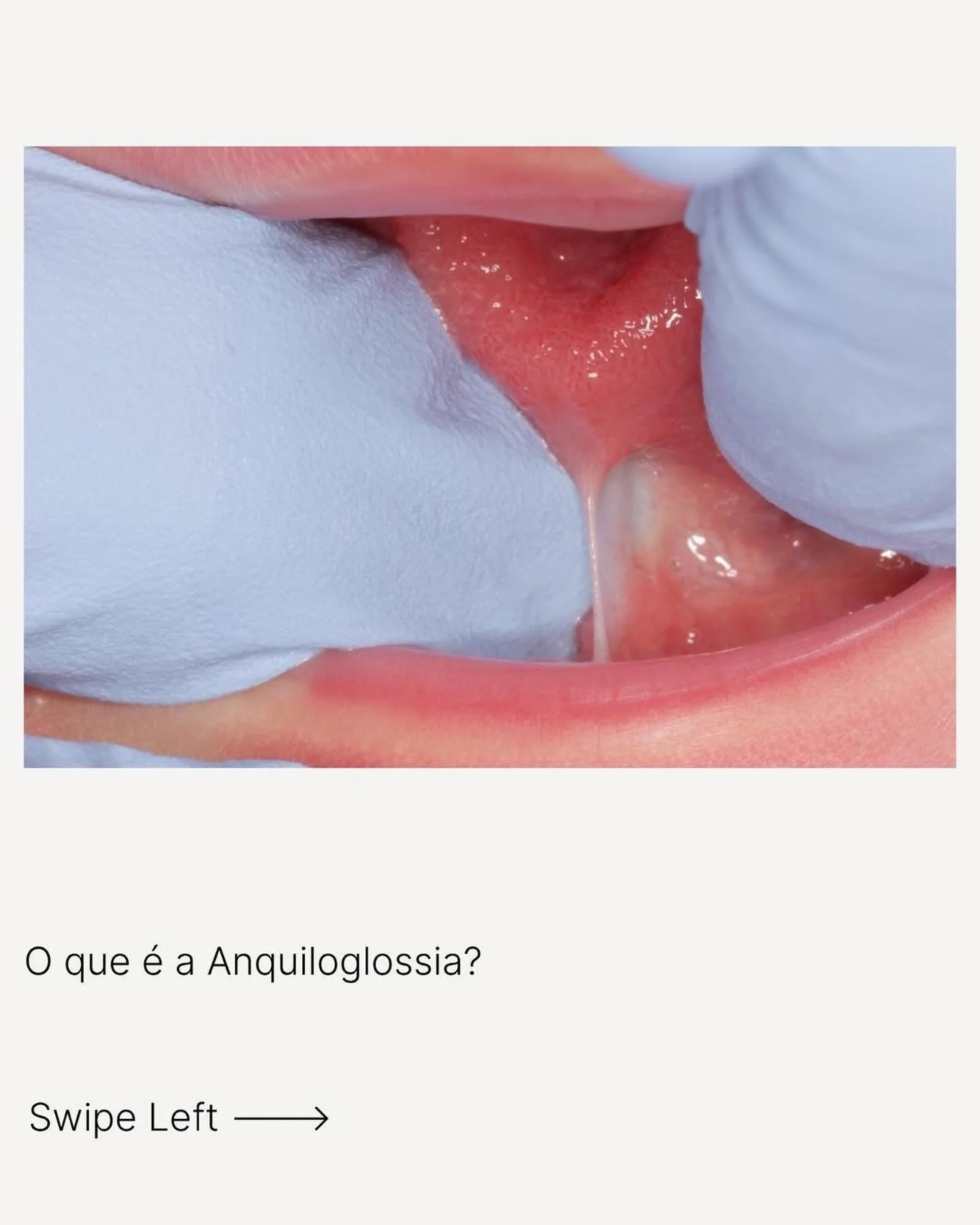 Afinal o que &eacute; a l&iacute;ngua presa (anquiloglossia)? 👅
⠀⠀⠀⠀⠀⠀⠀⠀⠀
Para ser considerada uma anquiloglossia deve existir n&atilde;o s&oacute; uma altera&ccedil;&atilde;o ANAT&Oacute;MICA mas tamb&eacute;m uma altera&ccedil;&atilde;o FUNCIONAL 