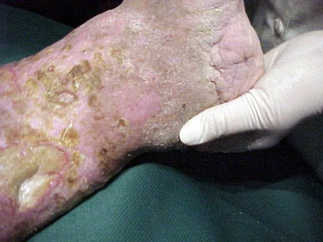 Curso avanzado de especialización "miembros inferiores"