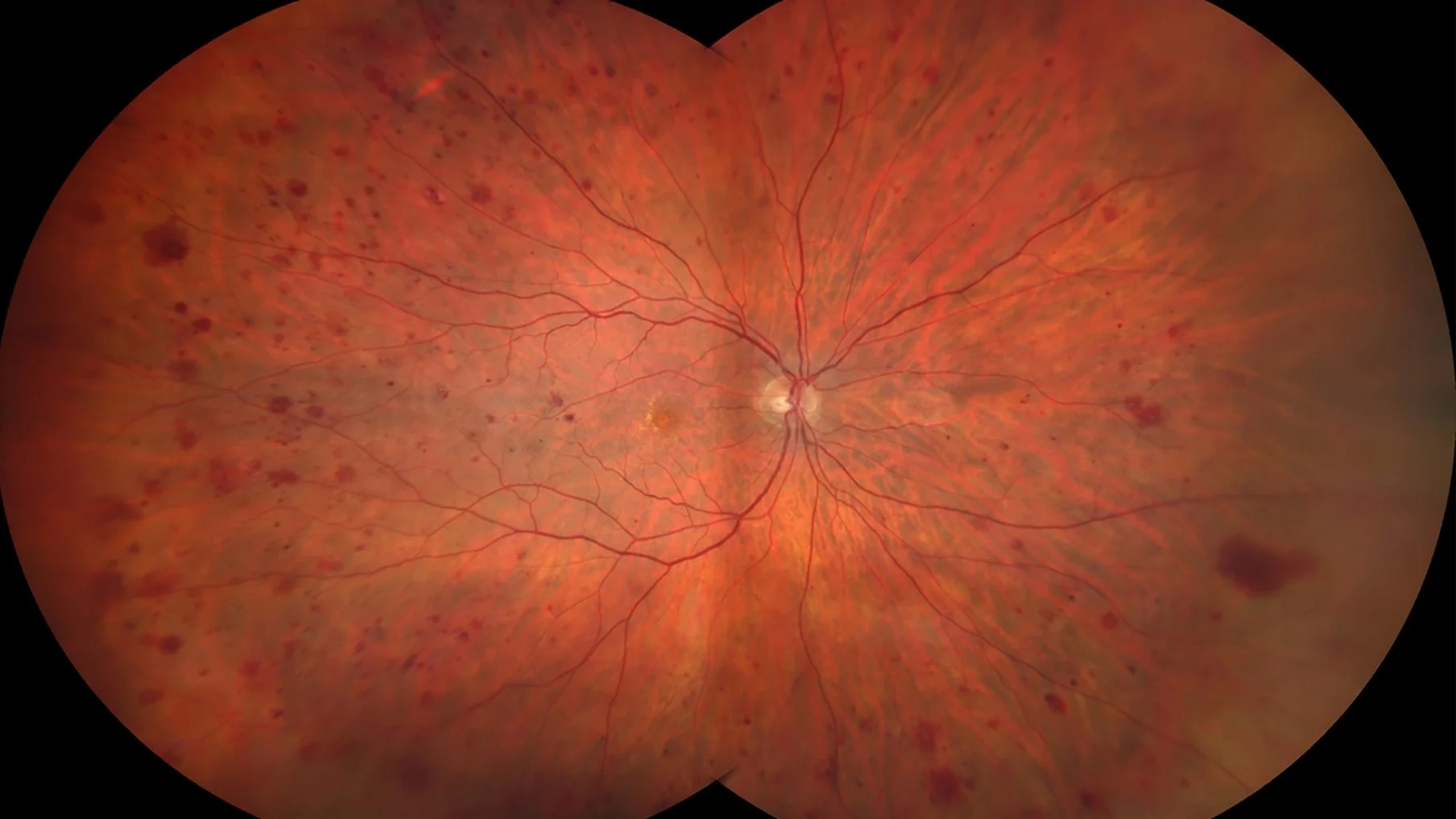 Retinal photo of diabetic retinopathy