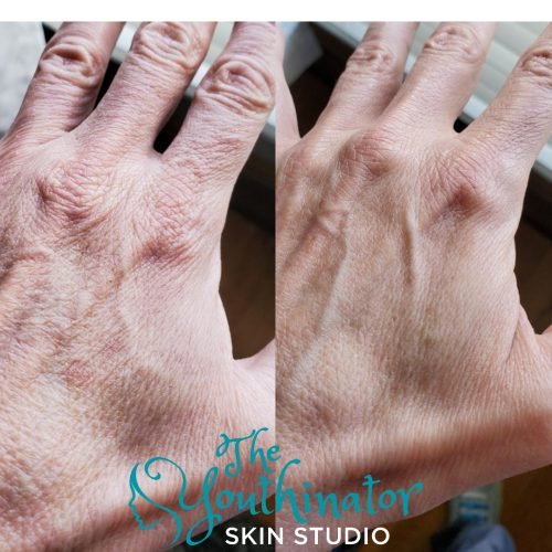 jetplasmapen_3treatments_2.jpg