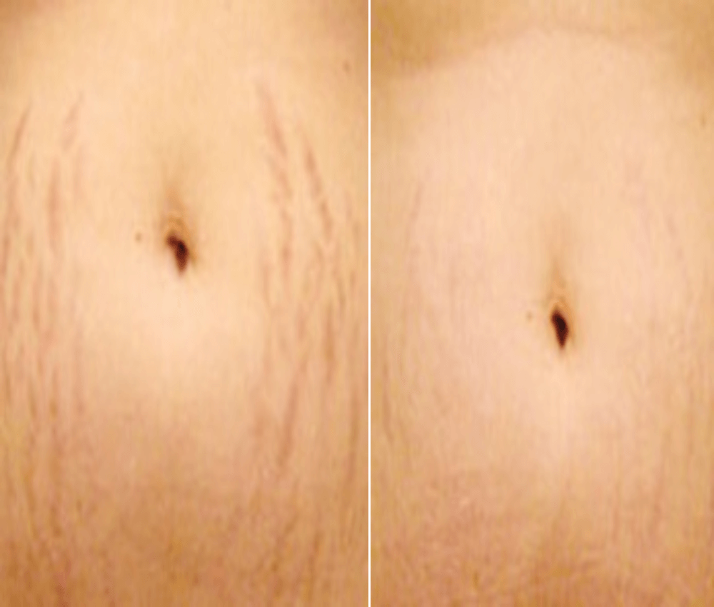 microchannelling-stretch-mark (1).png