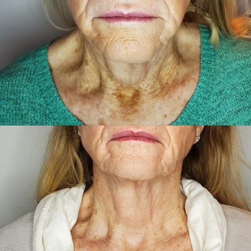jetplasmapen_10treatments.jpg