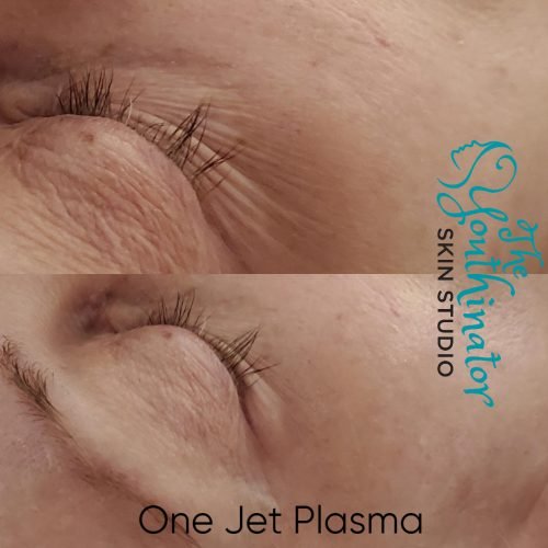 jetplasmapen_1treatment.png