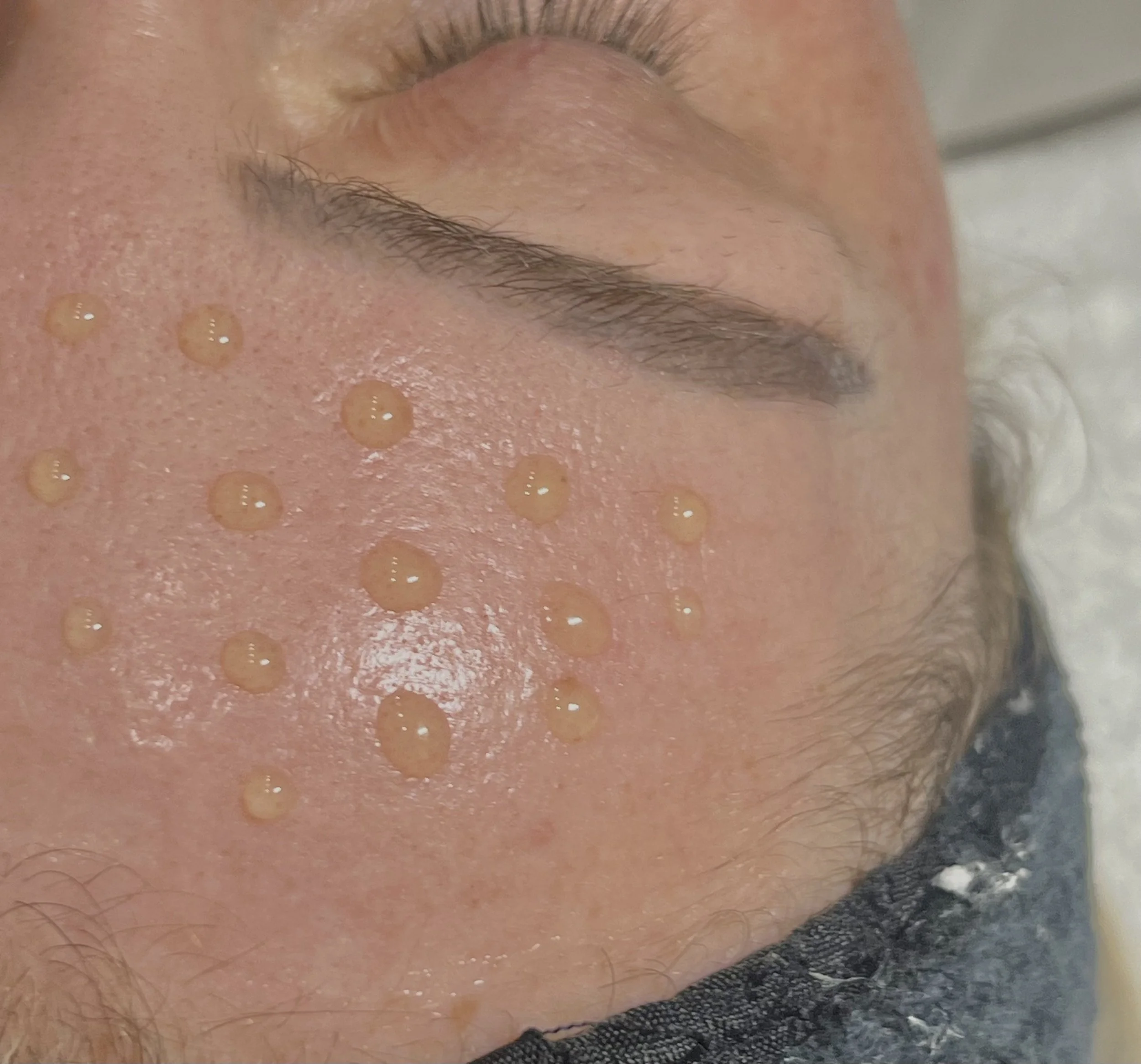 Close-up of a woman with redness, inflammation, and broken blood vessels on her face, possibly after a skincare procedure or due to a skin condition.