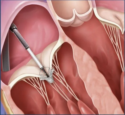 Tricuspid Valve Repair (Tricuspid Clip)
