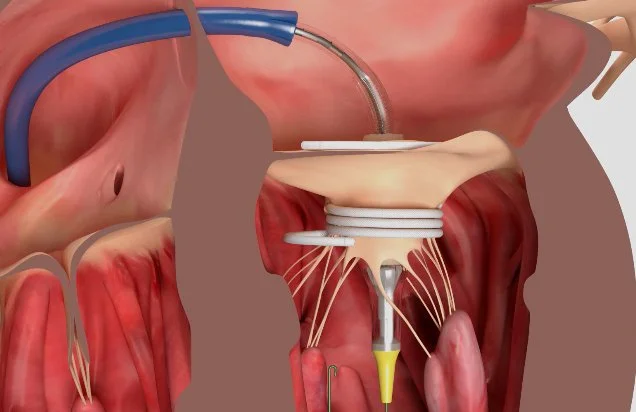 Mitral Valve Replacement (ENCIRCLE)