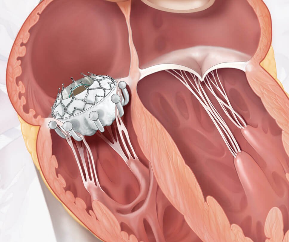 Tricuspid Valve Replacement (EVOQUE Valve)