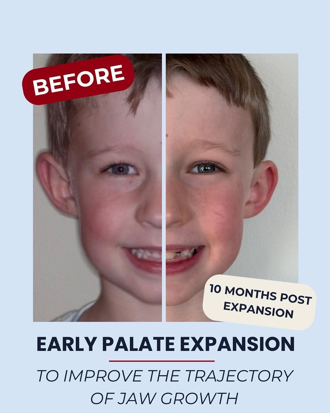 🚨 EARLY EXPANSION ALERT 🚨 
This kiddo was referred to me by his pediatric dentist! 
PATIENT:
treatment start: 6 years
treatment end: 7 years 3 months 

SYMPTOMS:
Open-mouth posture
Gummy Smile 
Recessed Mandible 

I did a complete myofunctional eva