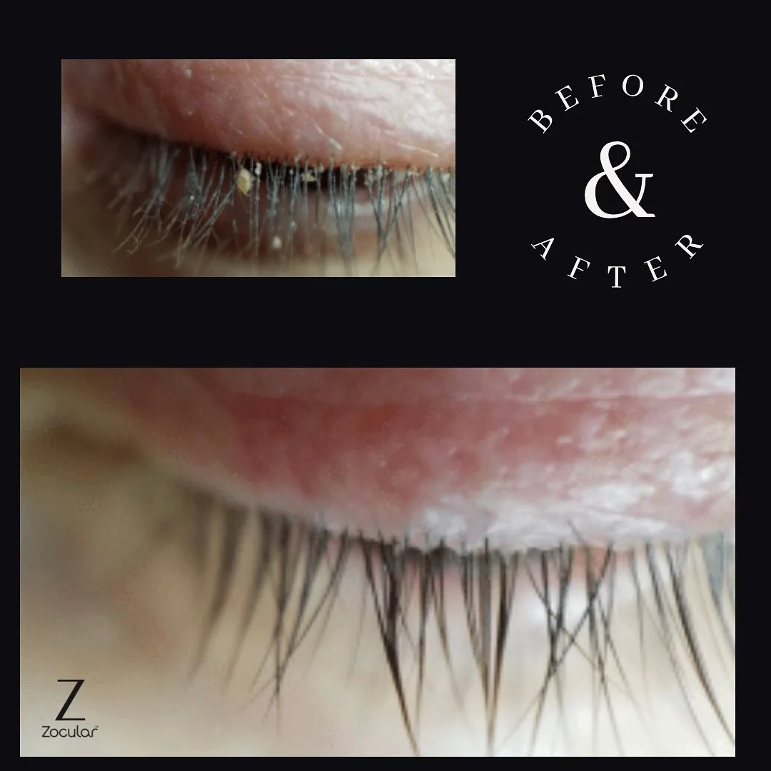 Close-up of an eyelid showing the before and after results of eyelash cleaning, with text indicating "Before & After" on a black background.