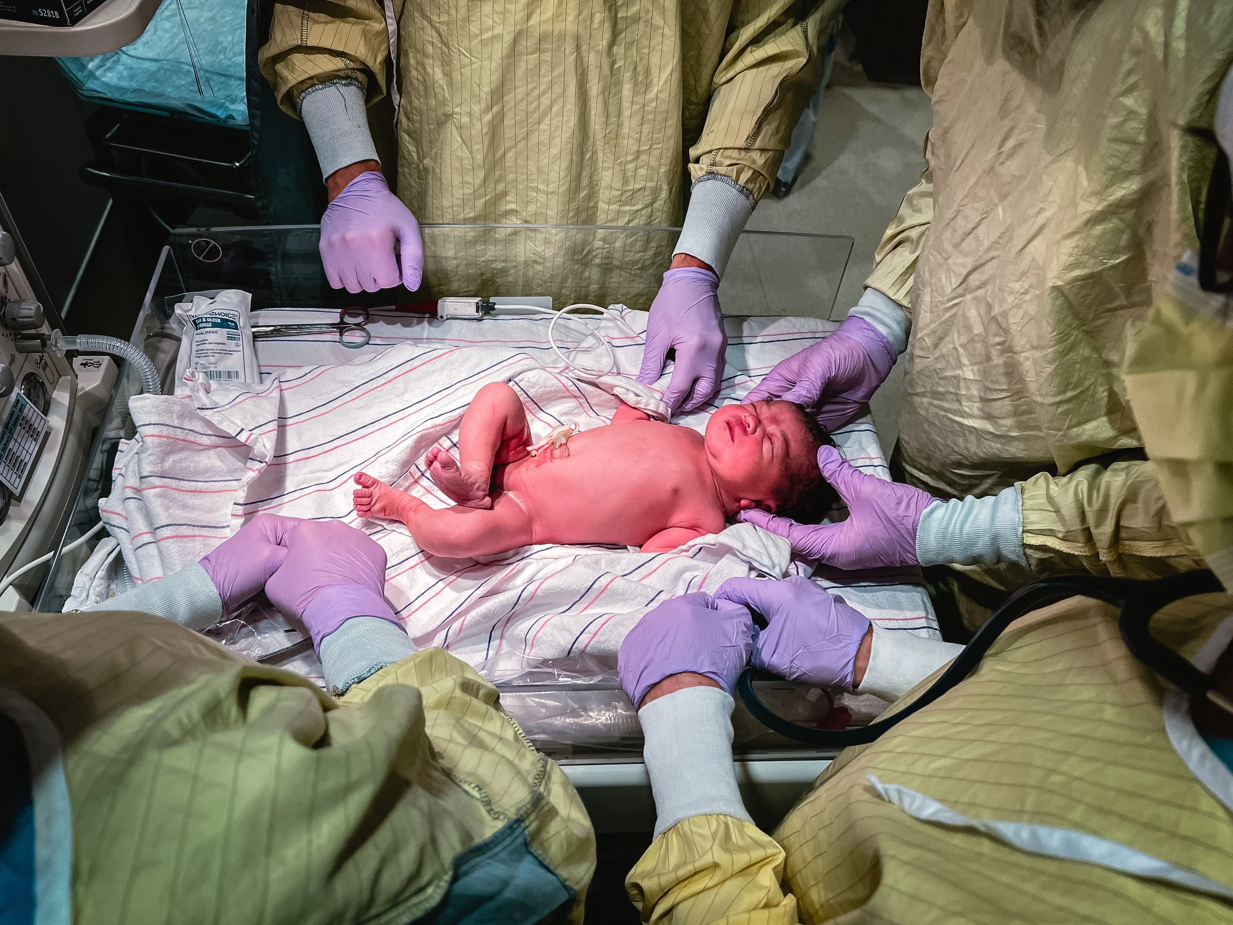  An overhead image of Beatrice in an infant warmer. Beatrice is perfectly pink, naked, and lying with her right leg crossing over her left, small toes flexed. Four nurses wear striped yellow gowns, hands cover in purple nitrate gloves. Their hands re
