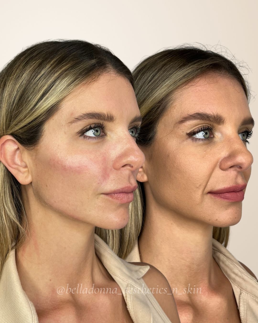 DM us for more info ❤️

Disclaimer: Information on Risks &amp; Recovery via link in bio. Bella Donna Aesthetics &amp; Skin provides multimodal aesthetic and skin treatments that may improve skin health, restore volume loss, address asymmetry and supp