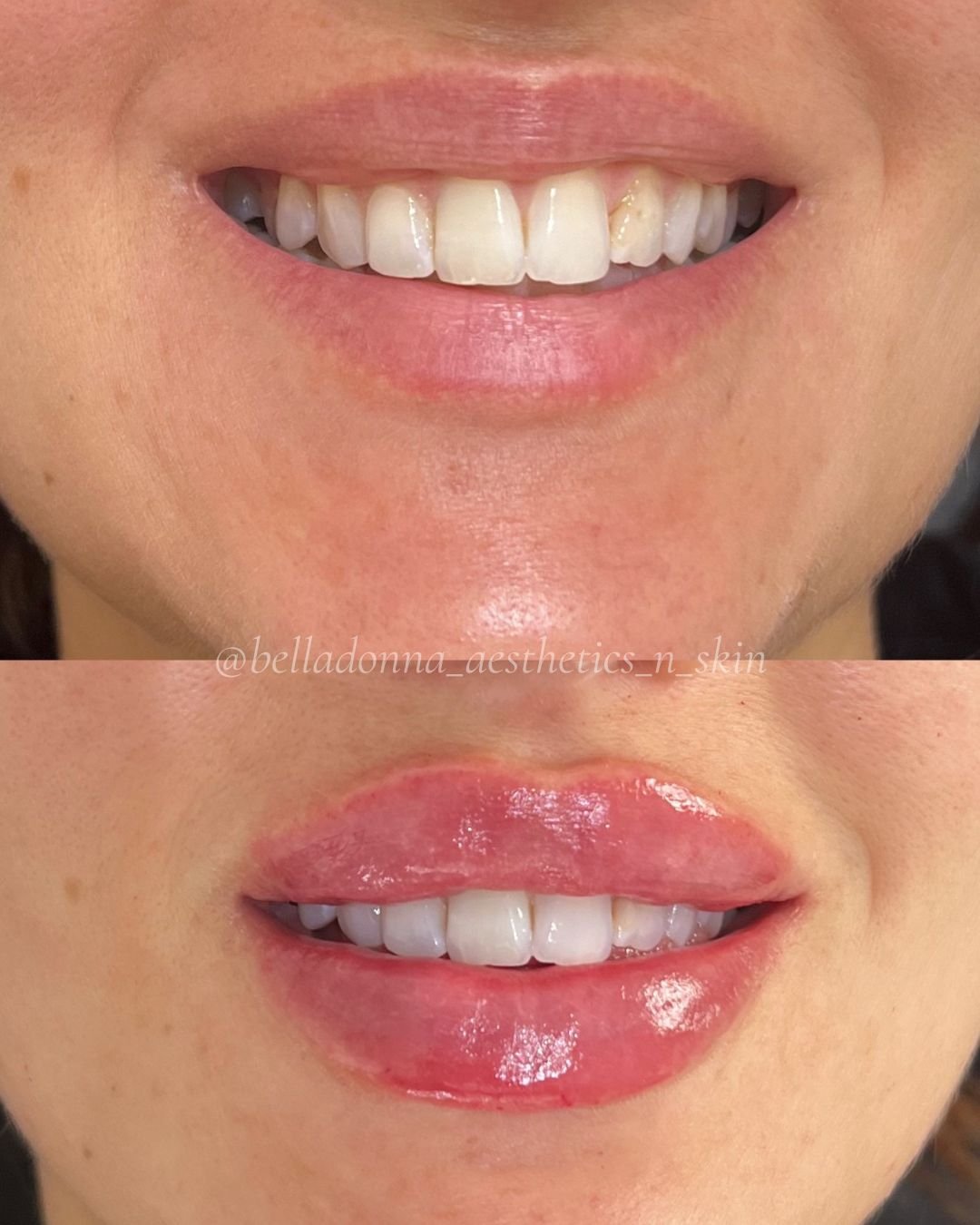 DM us for more info 🫶🏽

Disclaimer: Information on Risks &amp; Recovery via link in bio. Bella Donna Aesthetics &amp; Skin provides multimodal aesthetic and skin treatments that may improve skin health, restore volume loss, address asymmetry and su