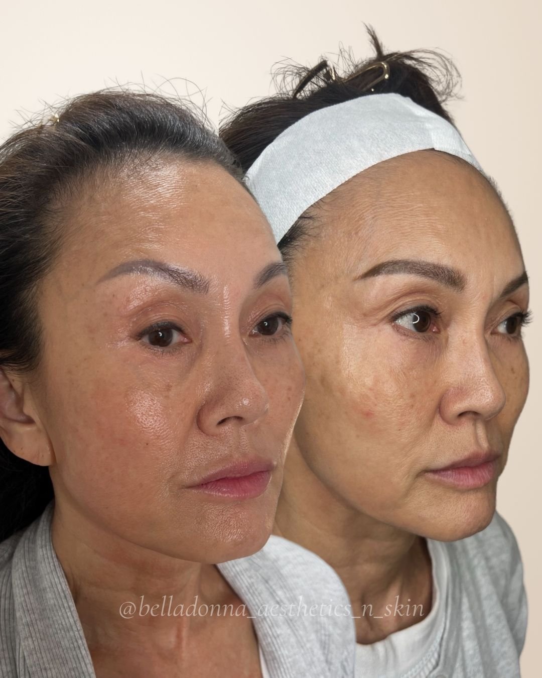 DM us for more info 🤍

Disclaimer: Information on Risks &amp; Recovery via link in bio. Bella Donna Aesthetics &amp; Skin provides multimodal aesthetic and skin treatments that may improve skin health, restore volume loss, address asymmetry and supp