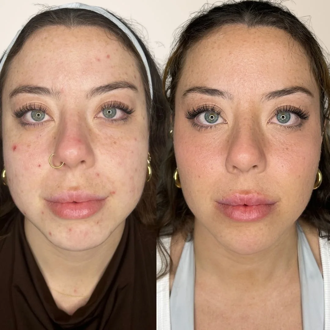 DM us for more info ❤️

Disclaimer: Information on Risks &amp; Recovery via link in bio. Bella Donna Aesthetics &amp; Skin provides multimodal aesthetic and skin treatments that may improve skin health, restore volume loss, address asymmetry and supp