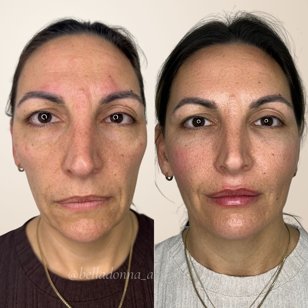 DM us for more info ❤️

Disclaimer: Information on Risks &amp; Recovery via link in bio. Bella Donna Aesthetics &amp; Skin provides multimodal aesthetic and skin treatments that may improve skin health, restore volume loss, address asymmetry and supp