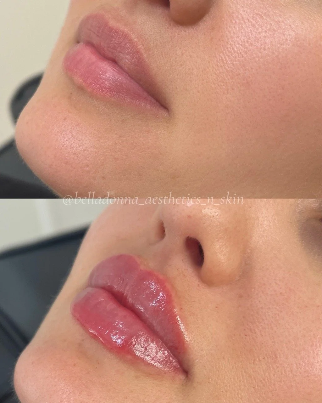 DM us for more info 💋

Disclaimer: Information on Risks &amp; Recovery via link in bio. Bella Donna Aesthetics &amp; Skin provides multimodal aesthetic and skin treatments that may improve skin health, restore volume loss, address asymmetry and supp
