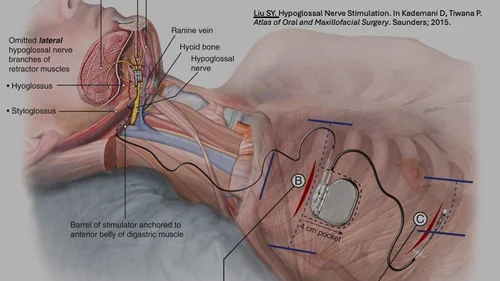 Medical illustration of the neck showing the hypoglossal nerve, from Dr. Liu's chapter on hypoglossal nerve stimulation