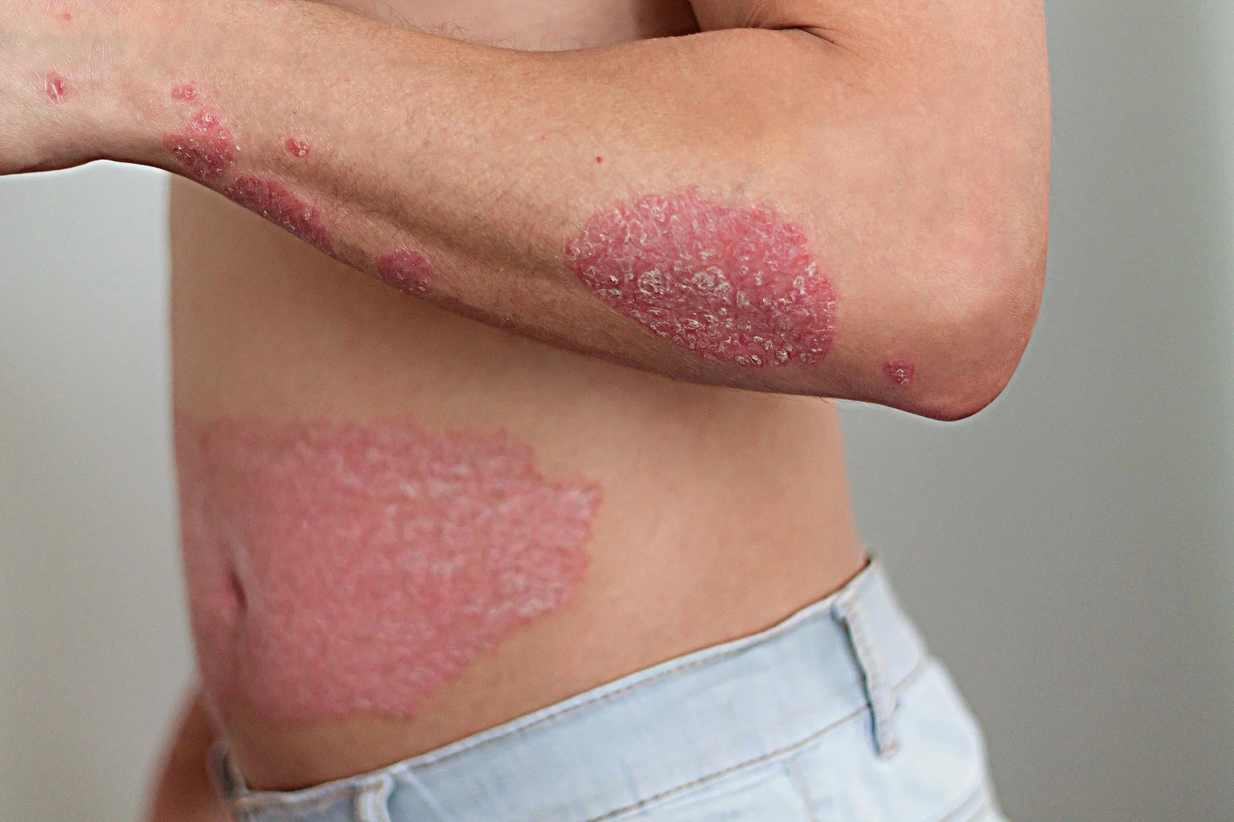The Gut-Skin Connection in Psoriasis: How Gut Health May Influence Symptoms