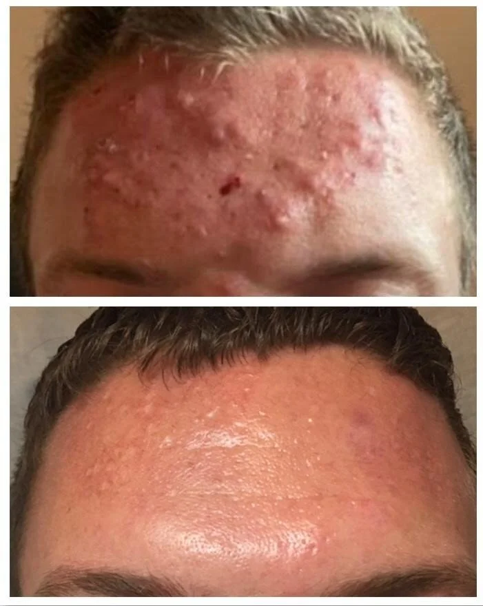 Acne client story
