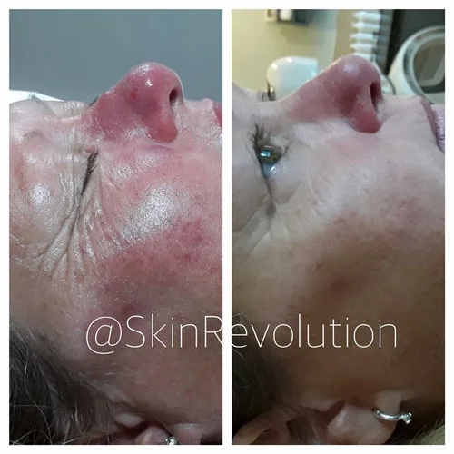 Rosacea client story
