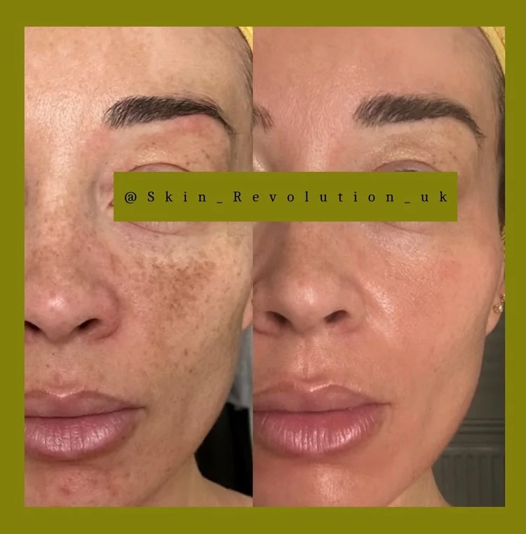 Melasma client story