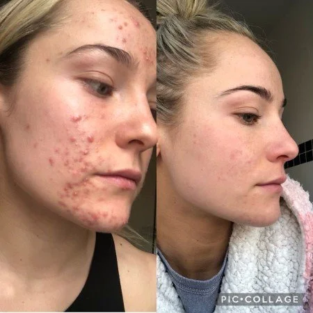 Acne client story